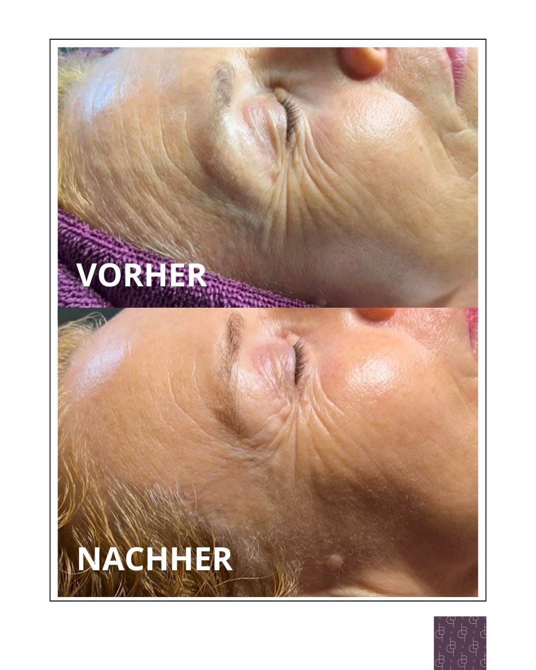 JetPeel vorher - nachher Vergleich