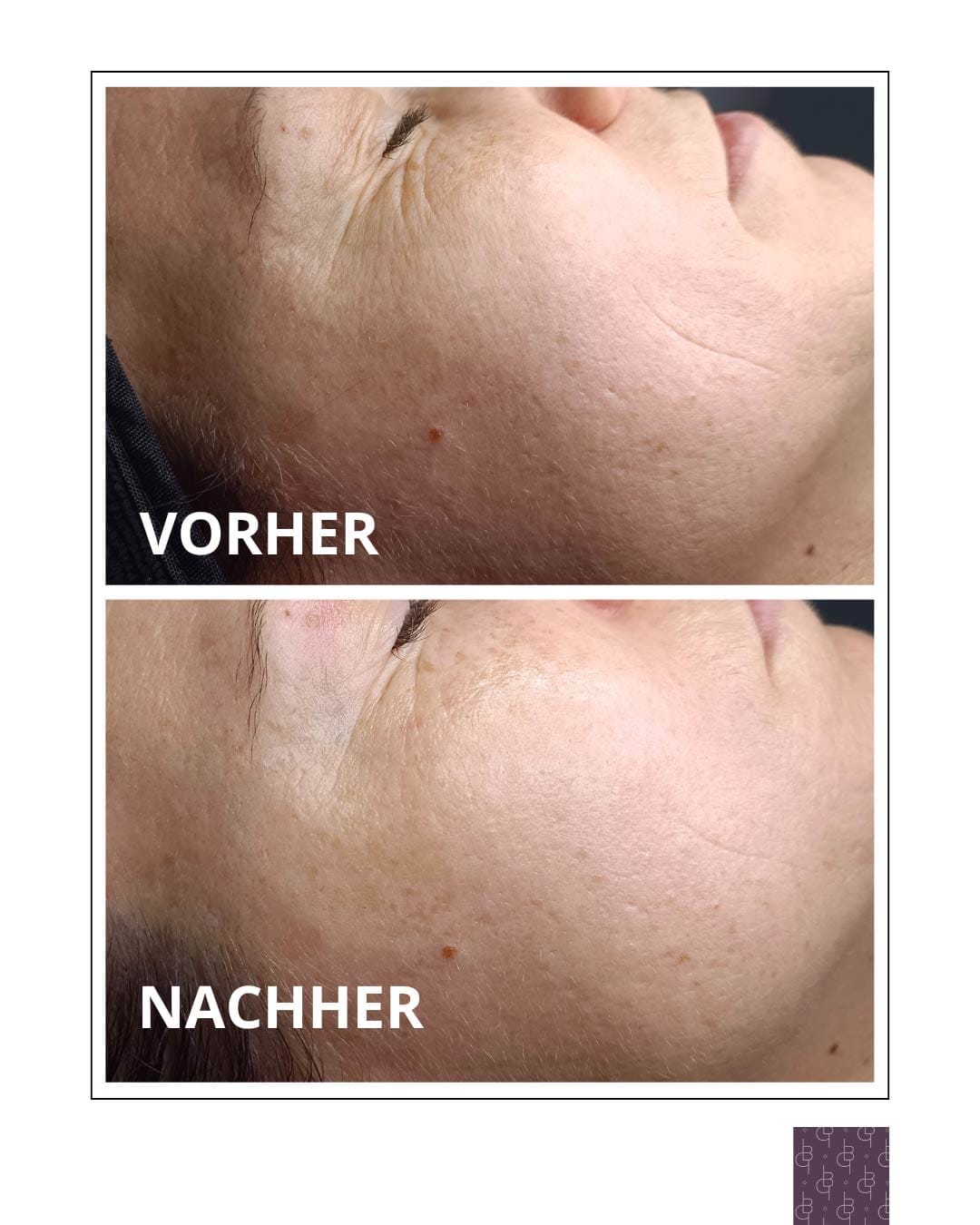 JetPeel vorher - nachher Vergleich