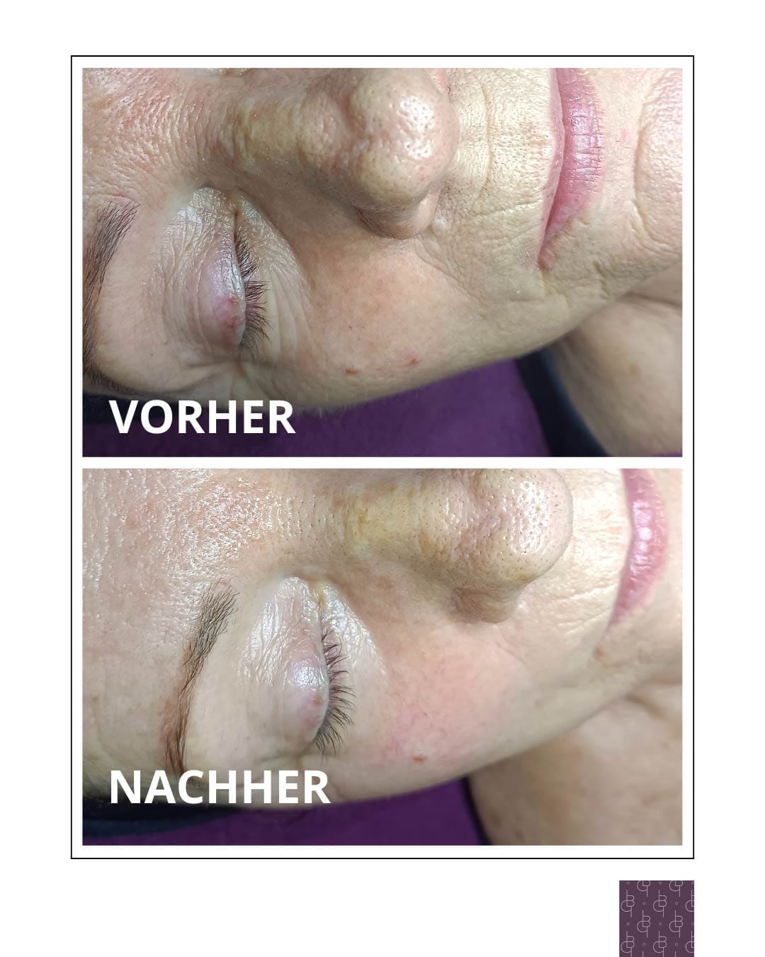 JetPeel vorher - nachher Vergleich